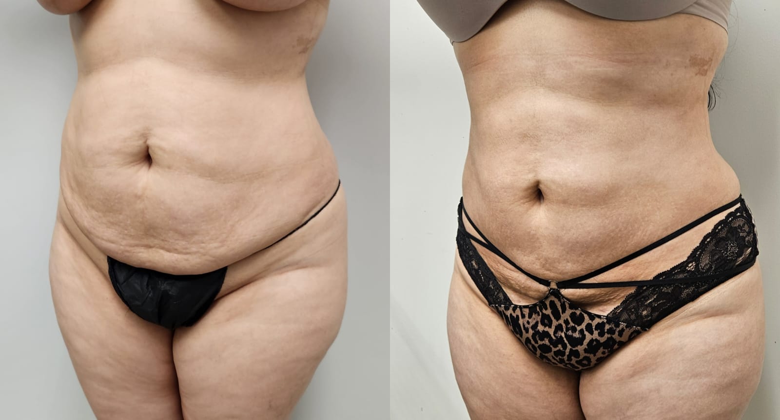 liposuction surgery before after results 2024