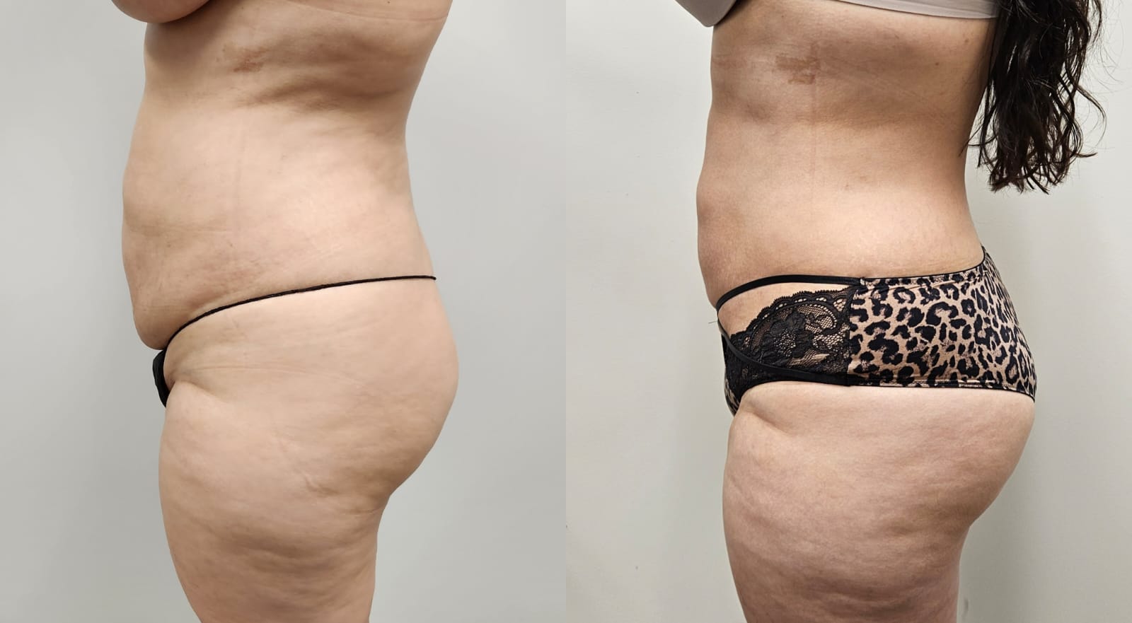 liposuction surgery before after results 2024