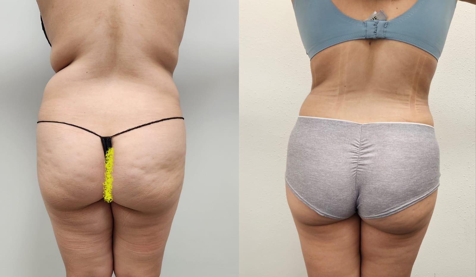 liposuction surgery before after results 2024