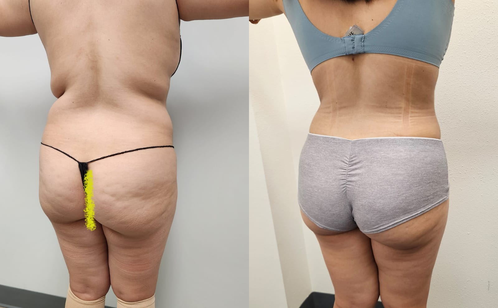 liposuction surgery before after results 2024