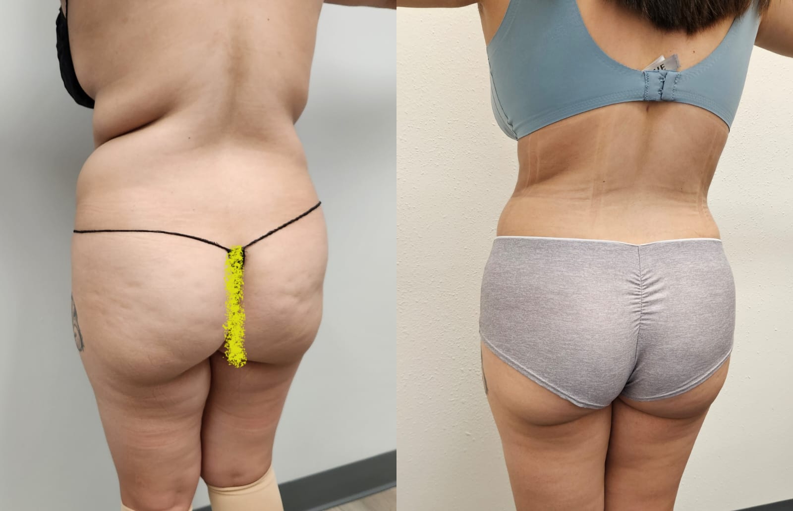 liposuction surgery before after results 2024