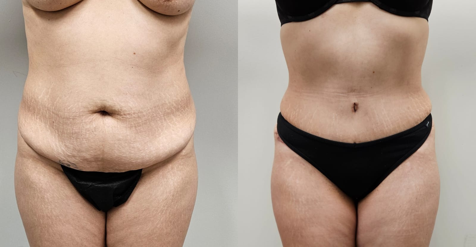 liposuction surgery before after results 2024