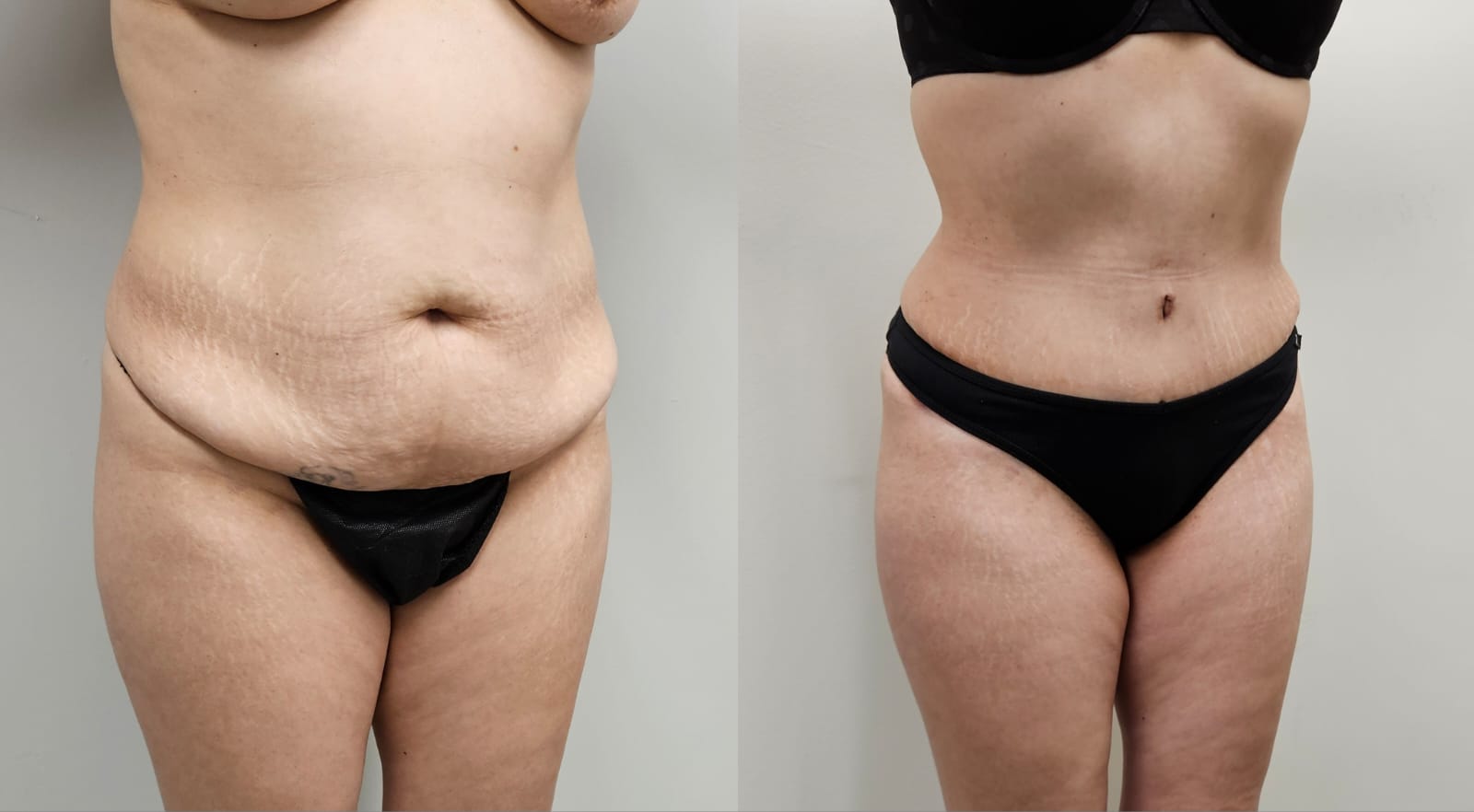 liposuction surgery before after results 2024