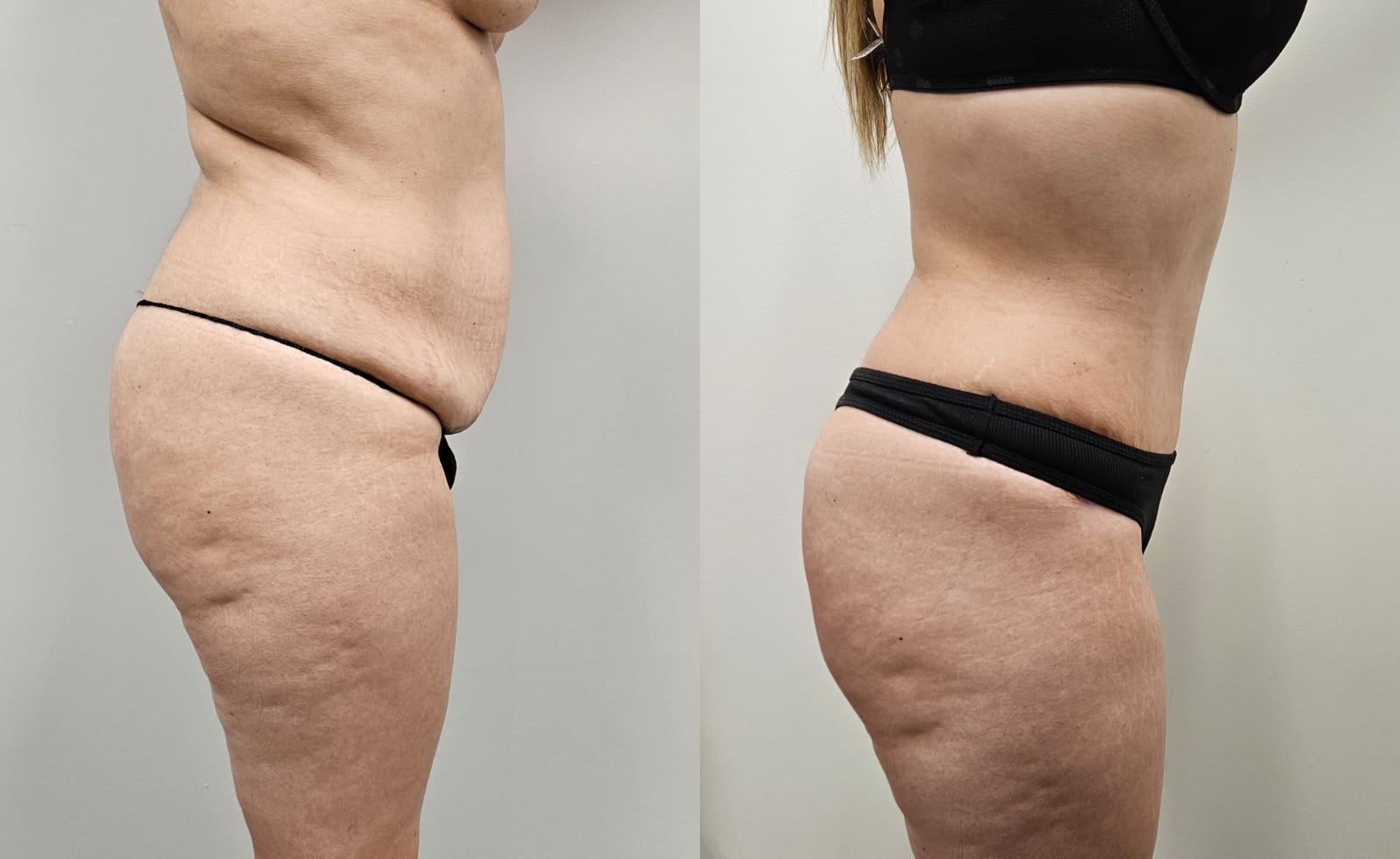 liposuction surgery before after results 2024