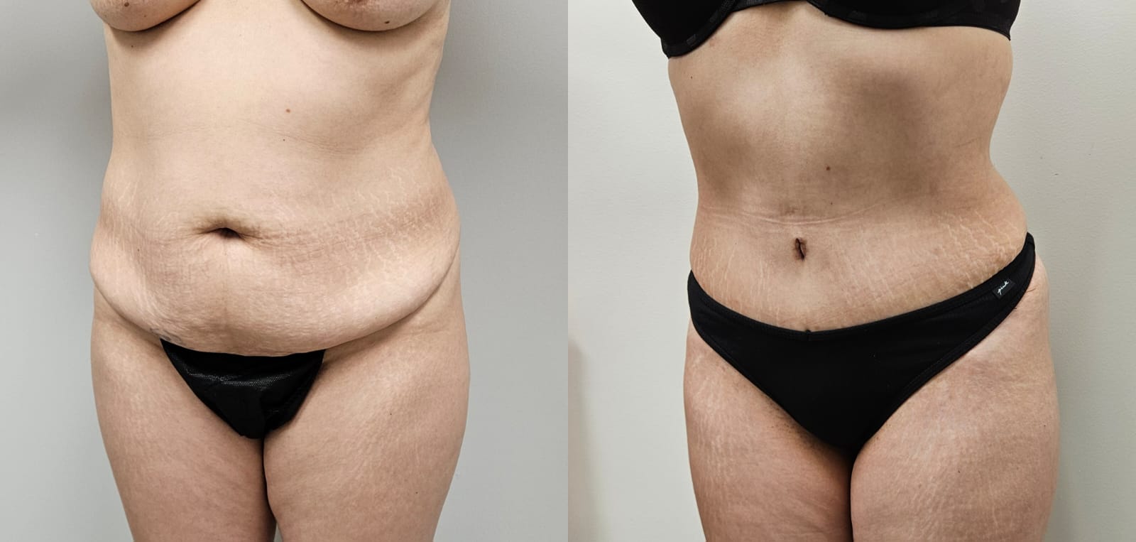 liposuction surgery before after results 2024