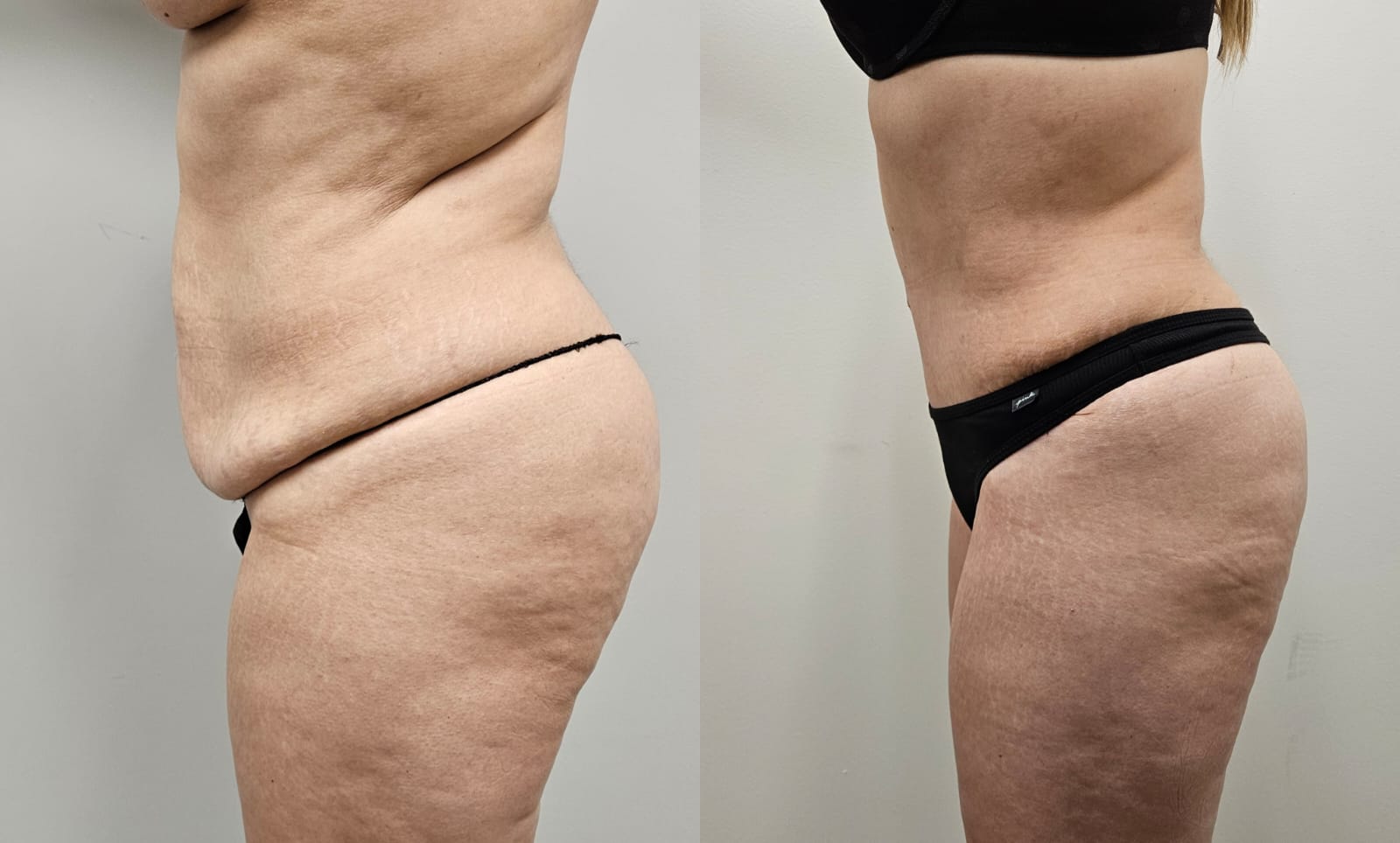 liposuction surgery before after results 2024