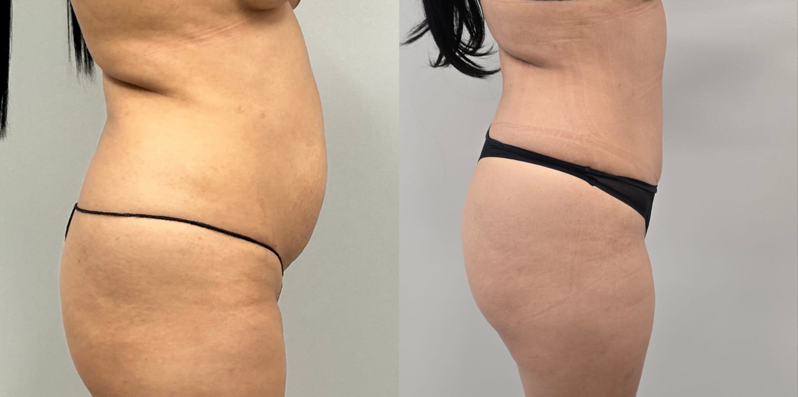 liposuction surgery before after results 2024