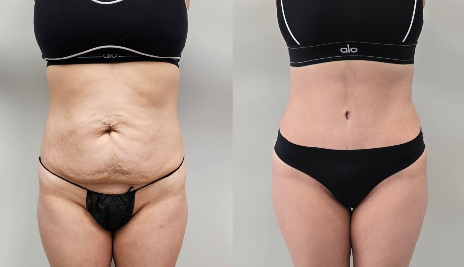 liposuction surgery before after results 2024