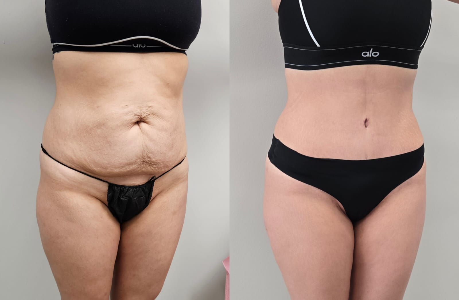 liposuction surgery before after results 2024