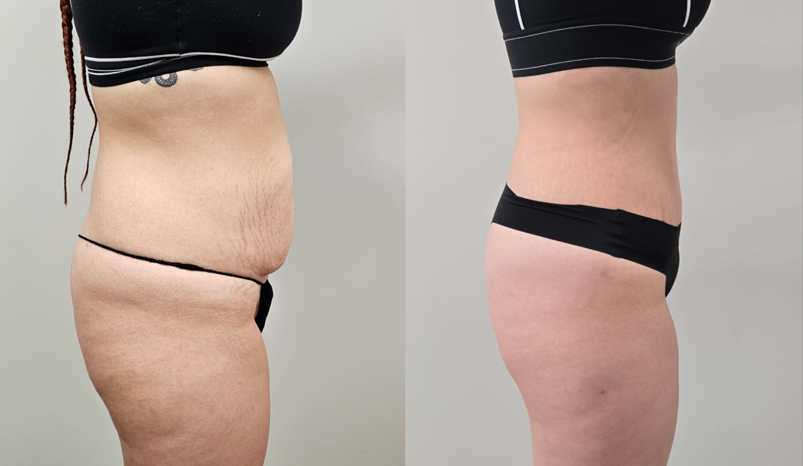 liposuction surgery before after results 2024