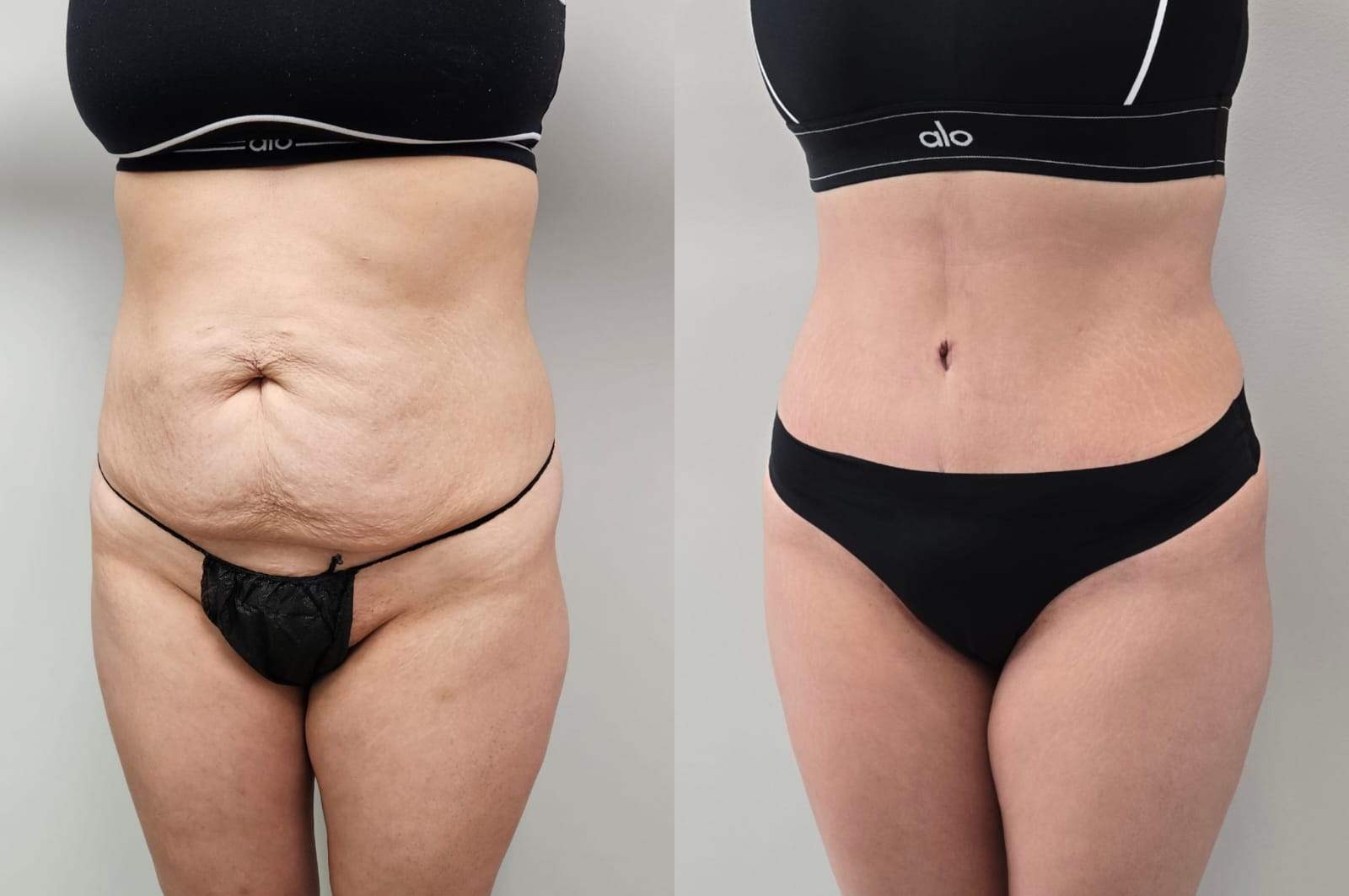 liposuction surgery before after results 2024