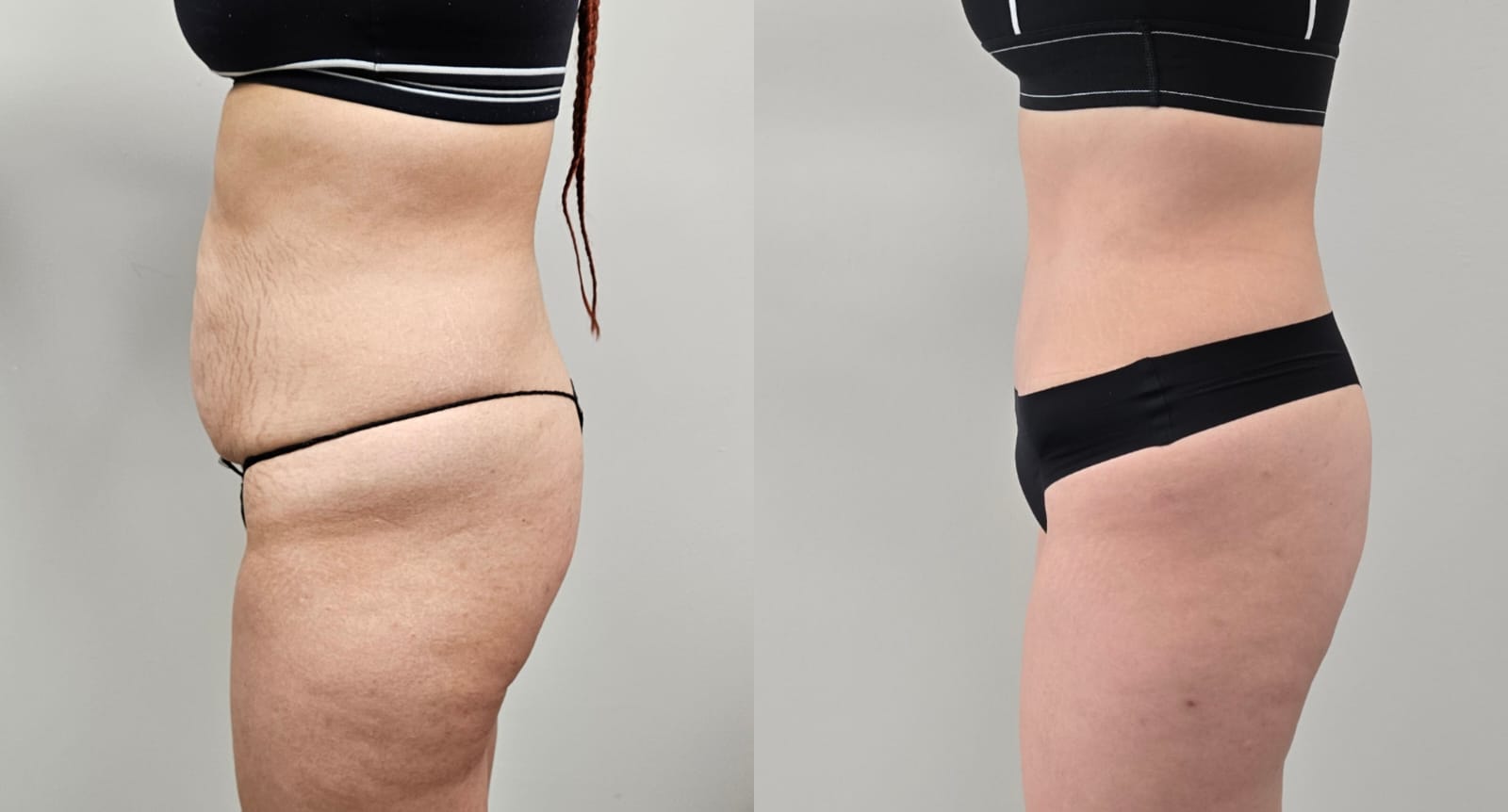 liposuction surgery before after results 2024