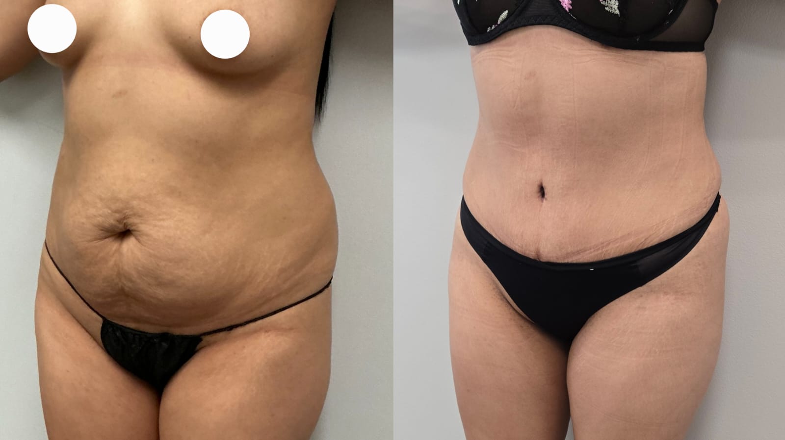 liposuction surgery before after results 2024