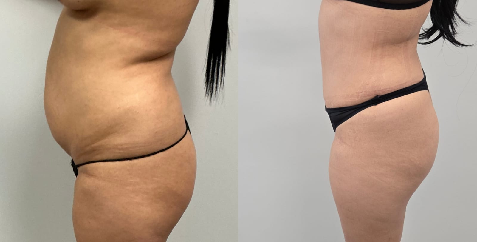 liposuction surgery before after results 2024