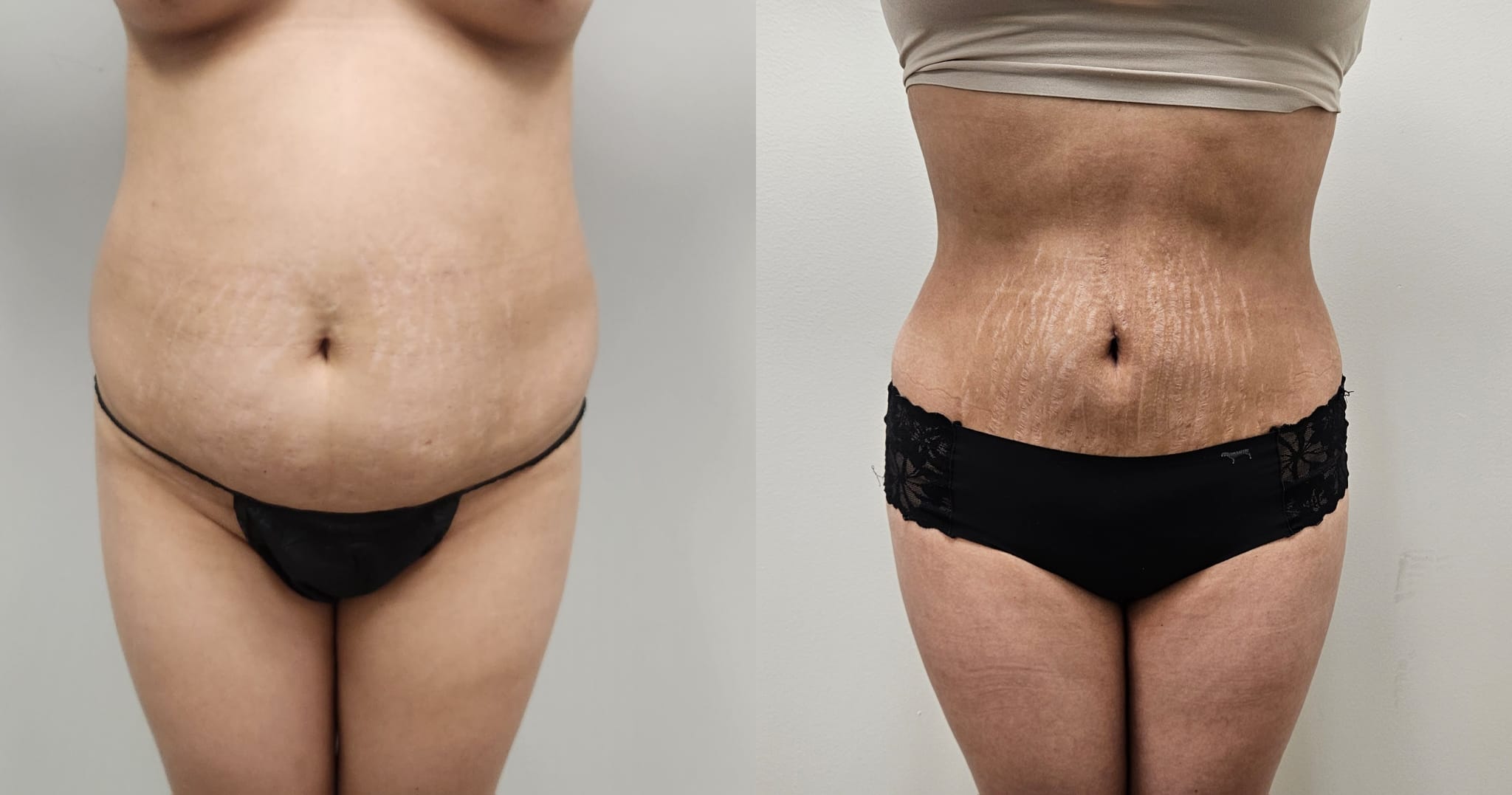 liposuction surgery before after results 2024