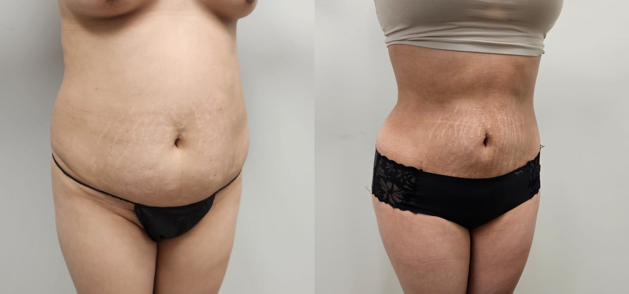 liposuction surgery before after results 2024