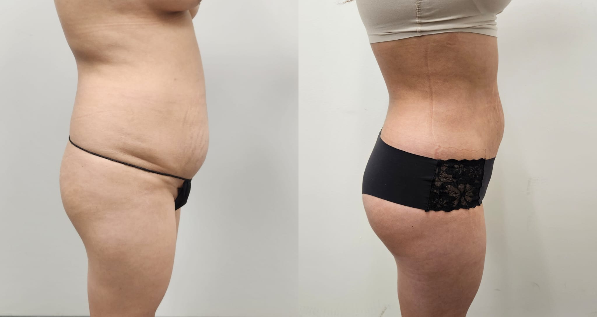 liposuction surgery before after results 2024