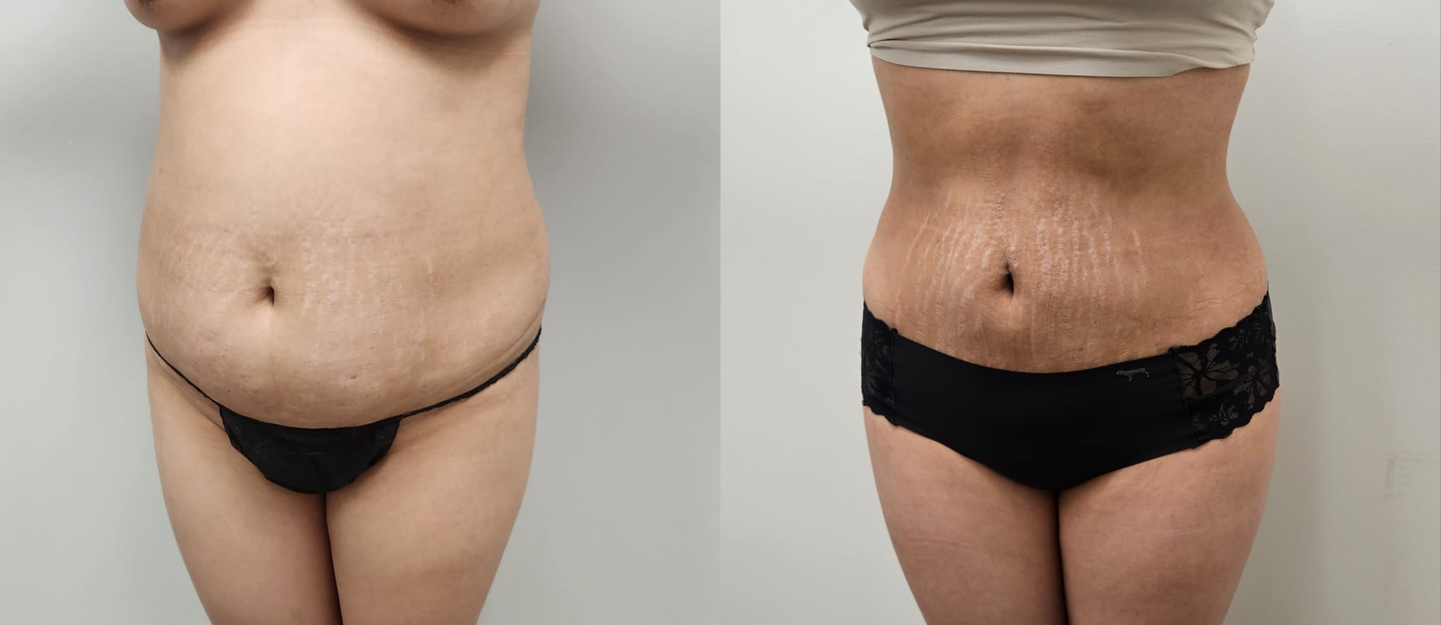 liposuction surgery before after results 2024