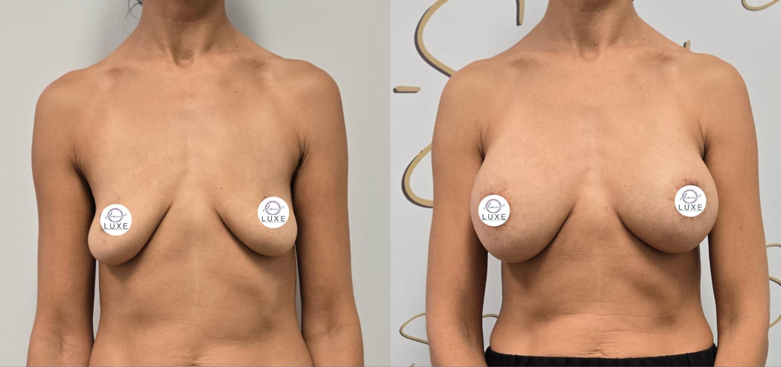 best breast augmentation before after results 2024