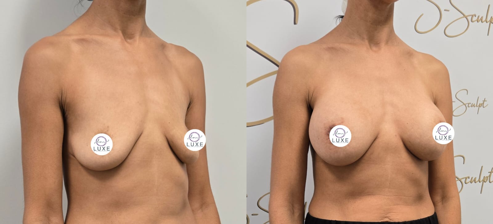 best breast augmentation before after results 2024