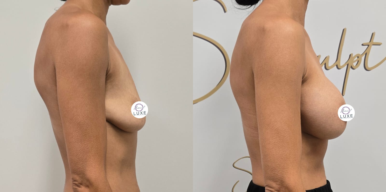 best breast augmentation before after results 2024