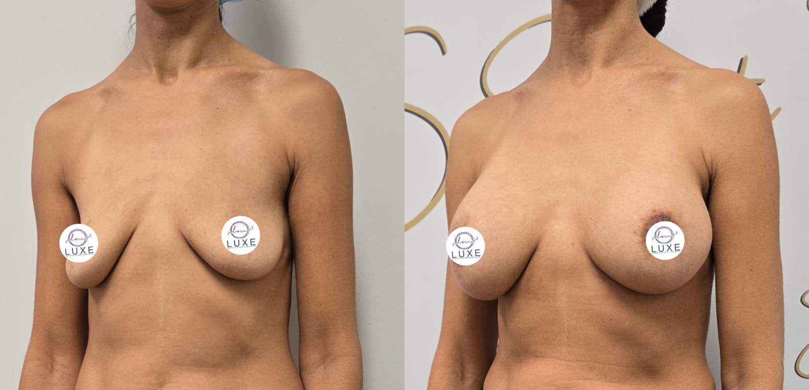 best breast augmentation before after results 2024