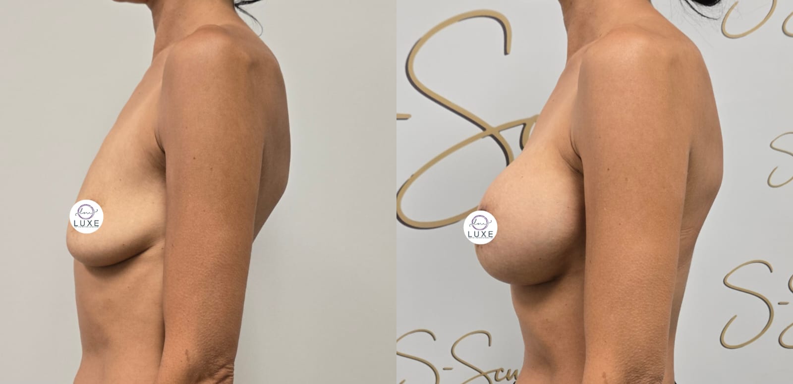 best breast augmentation before after results 2024
