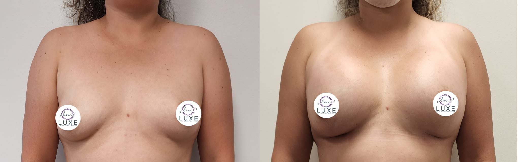 best breast augmentation before after results 2024