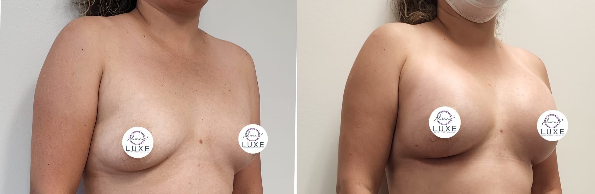 best breast augmentation before after results 2024