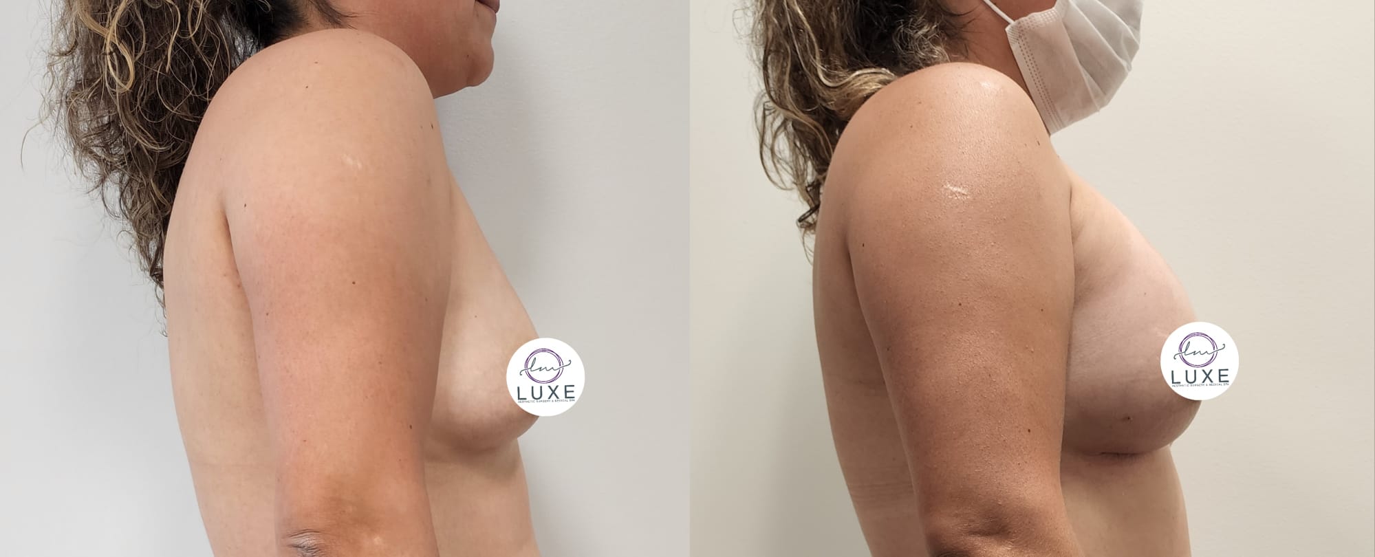 best breast augmentation before after results 2024