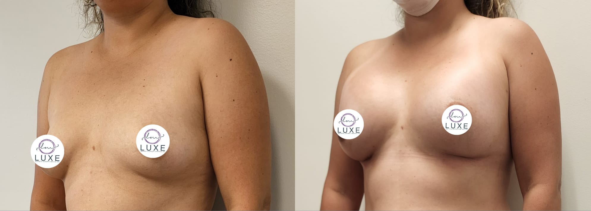 best breast augmentation before after results 2024