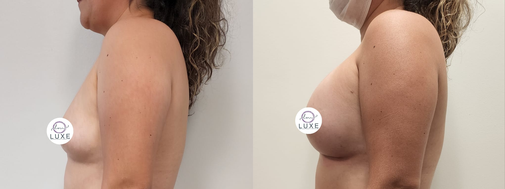 best breast augmentation before after results 2024