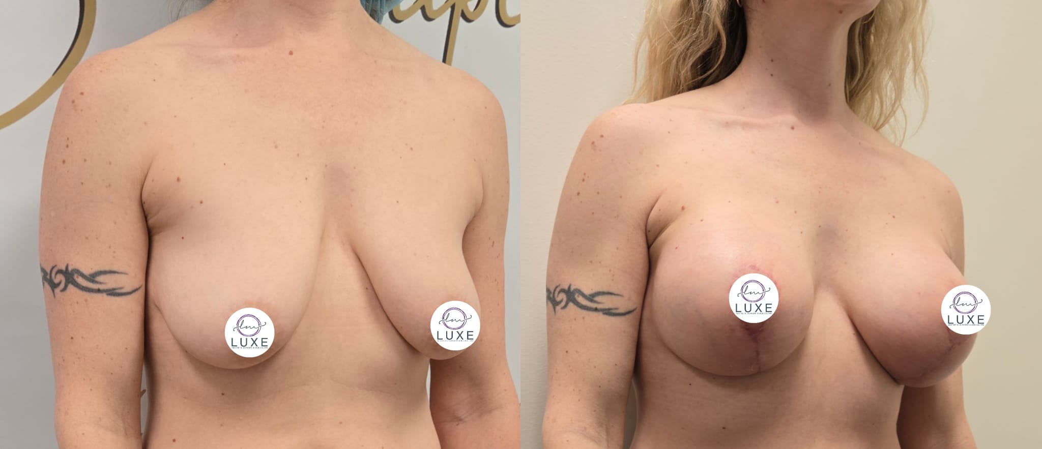 best breast lift ventura