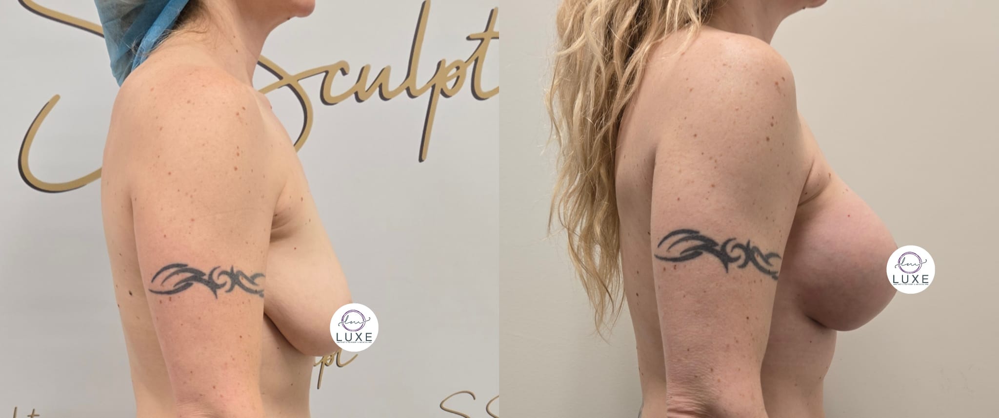 best breast lift ventura