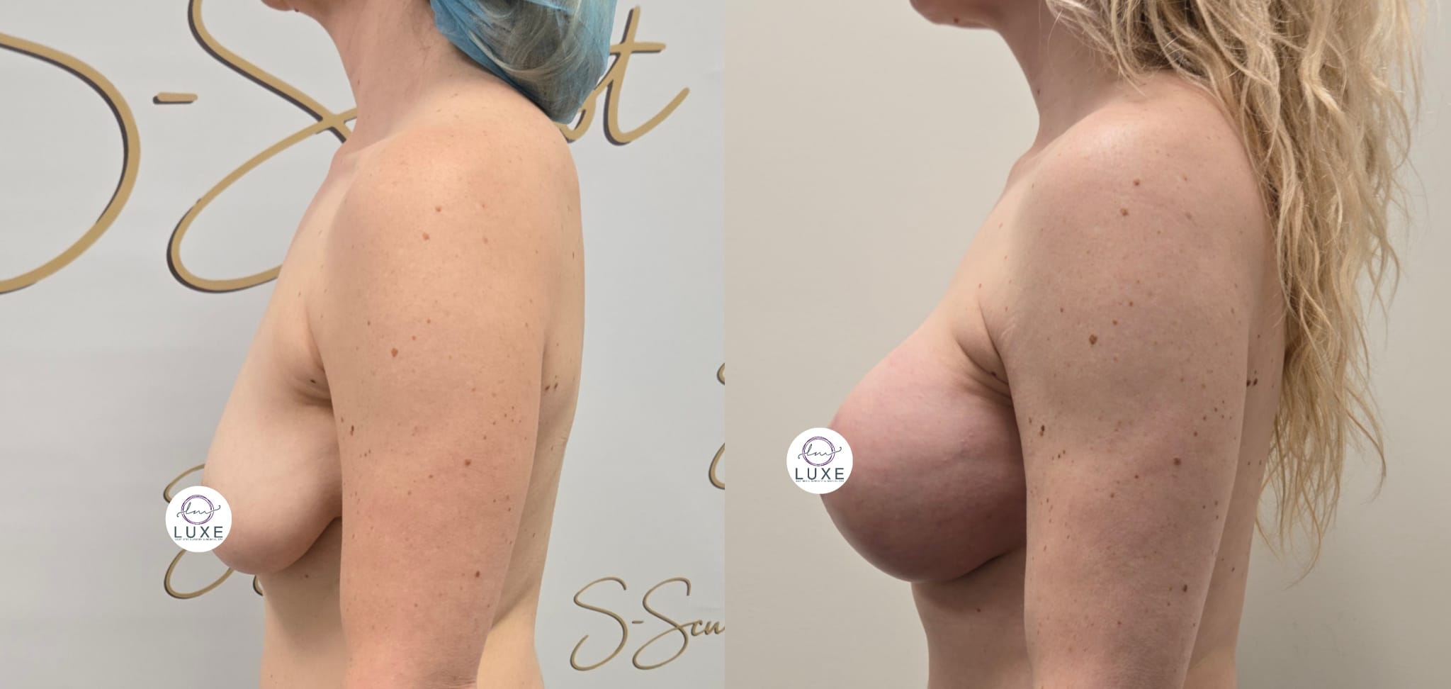 best breast lift ventura