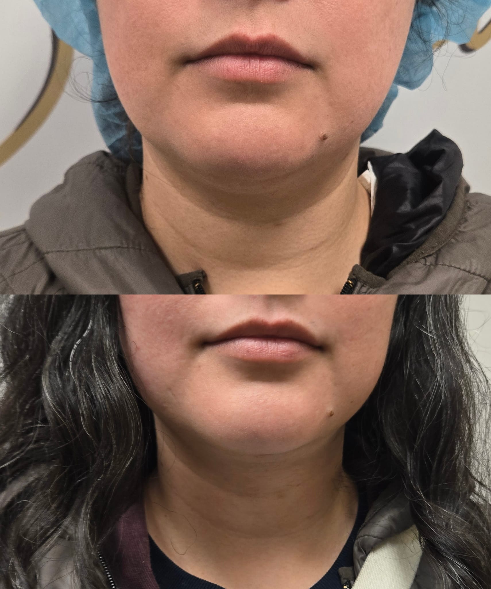 liposuction top treatment surgery in Oxnard