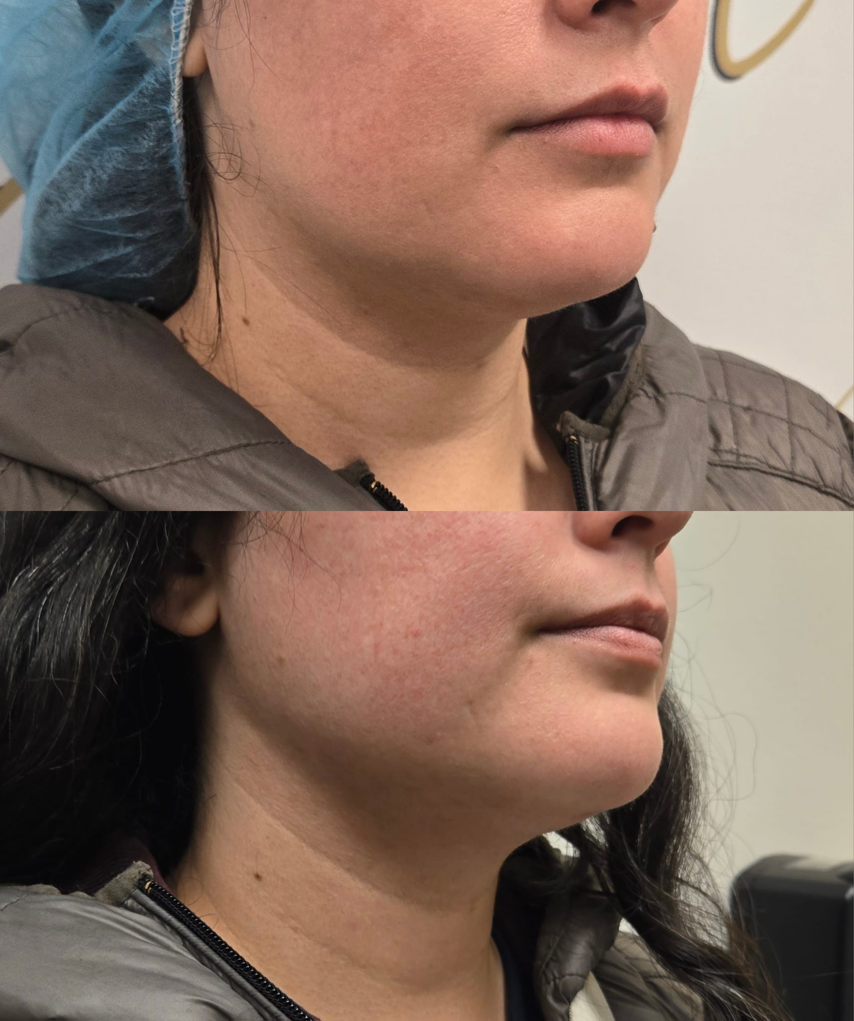 liposuction top treatment surgery in Oxnard