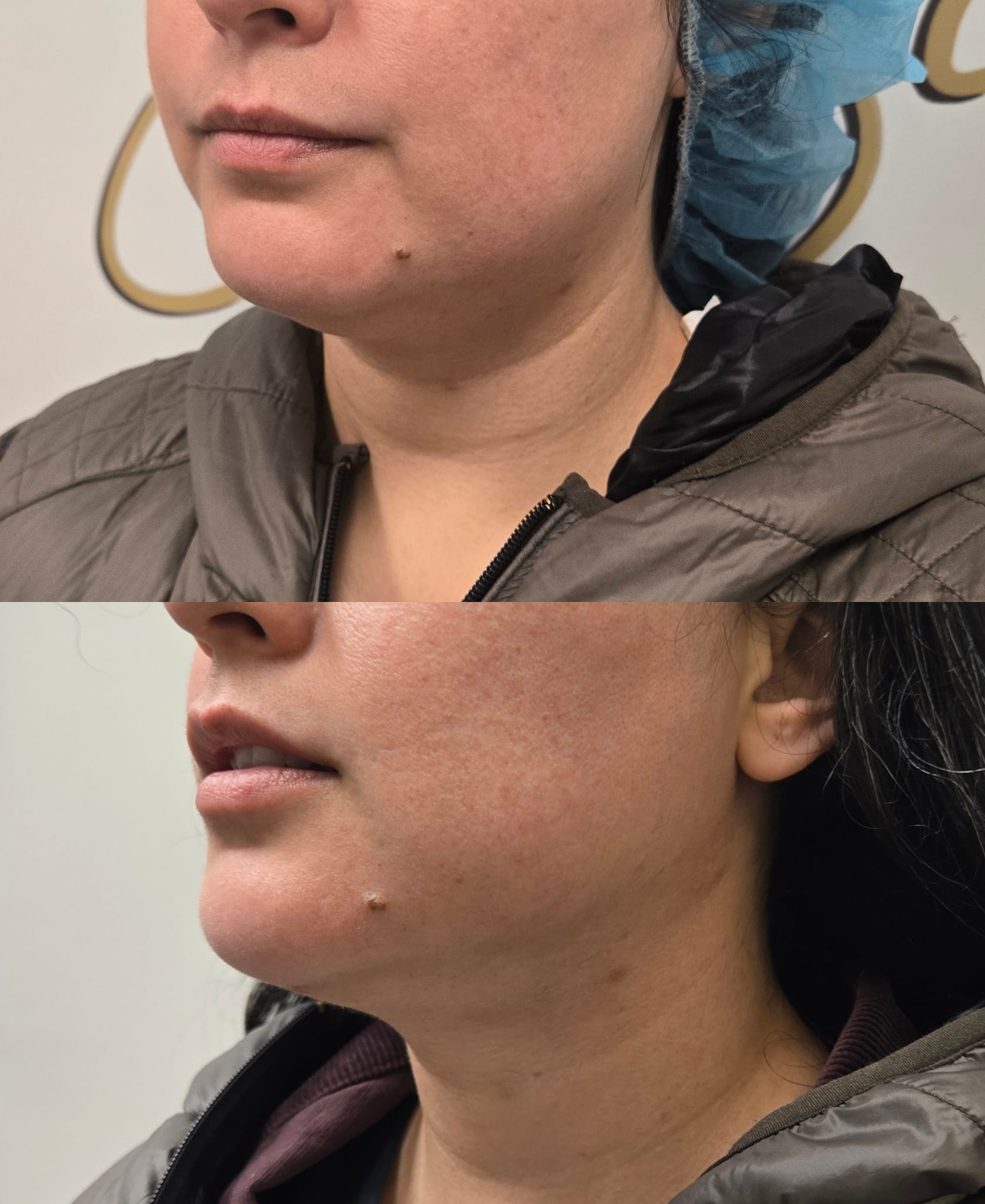 liposuction top treatment surgery in Oxnard