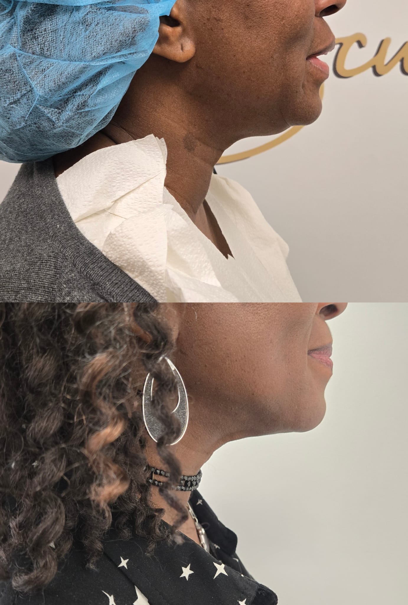 liposuction top treatment surgery in Oxnard