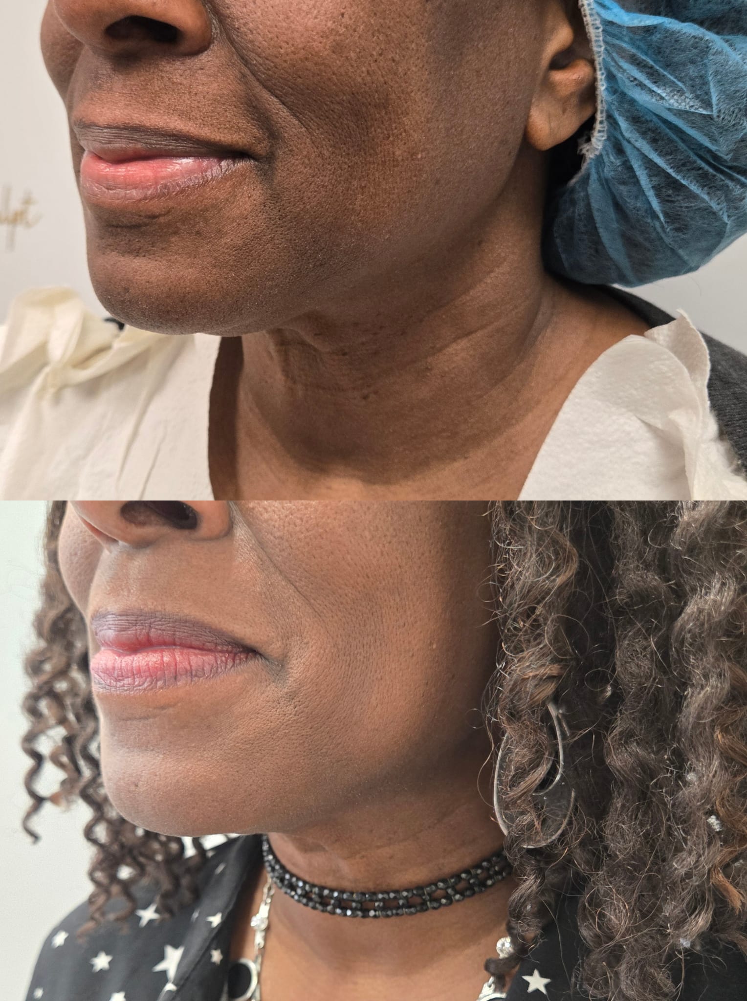 liposuction top treatment surgery in Oxnard