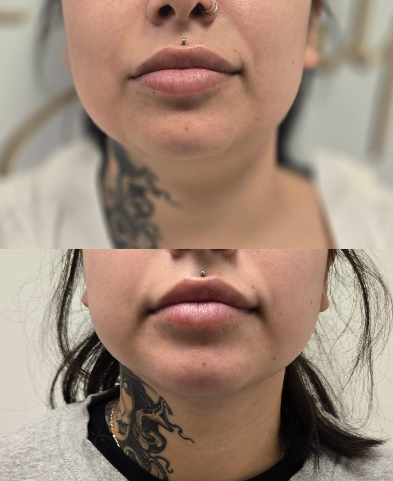 liposuction top treatment surgery in Oxnard