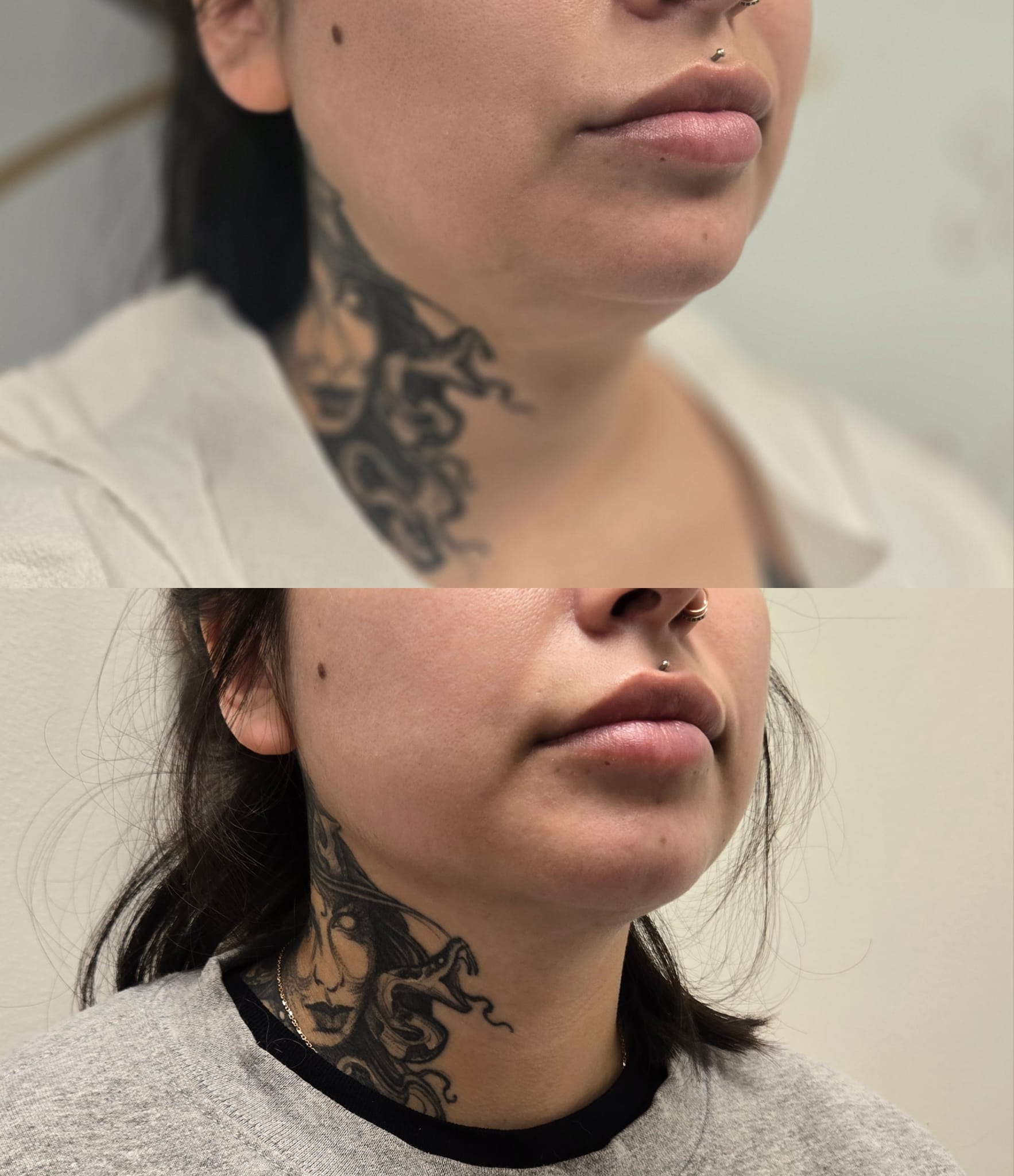 liposuction top treatment surgery in Oxnard