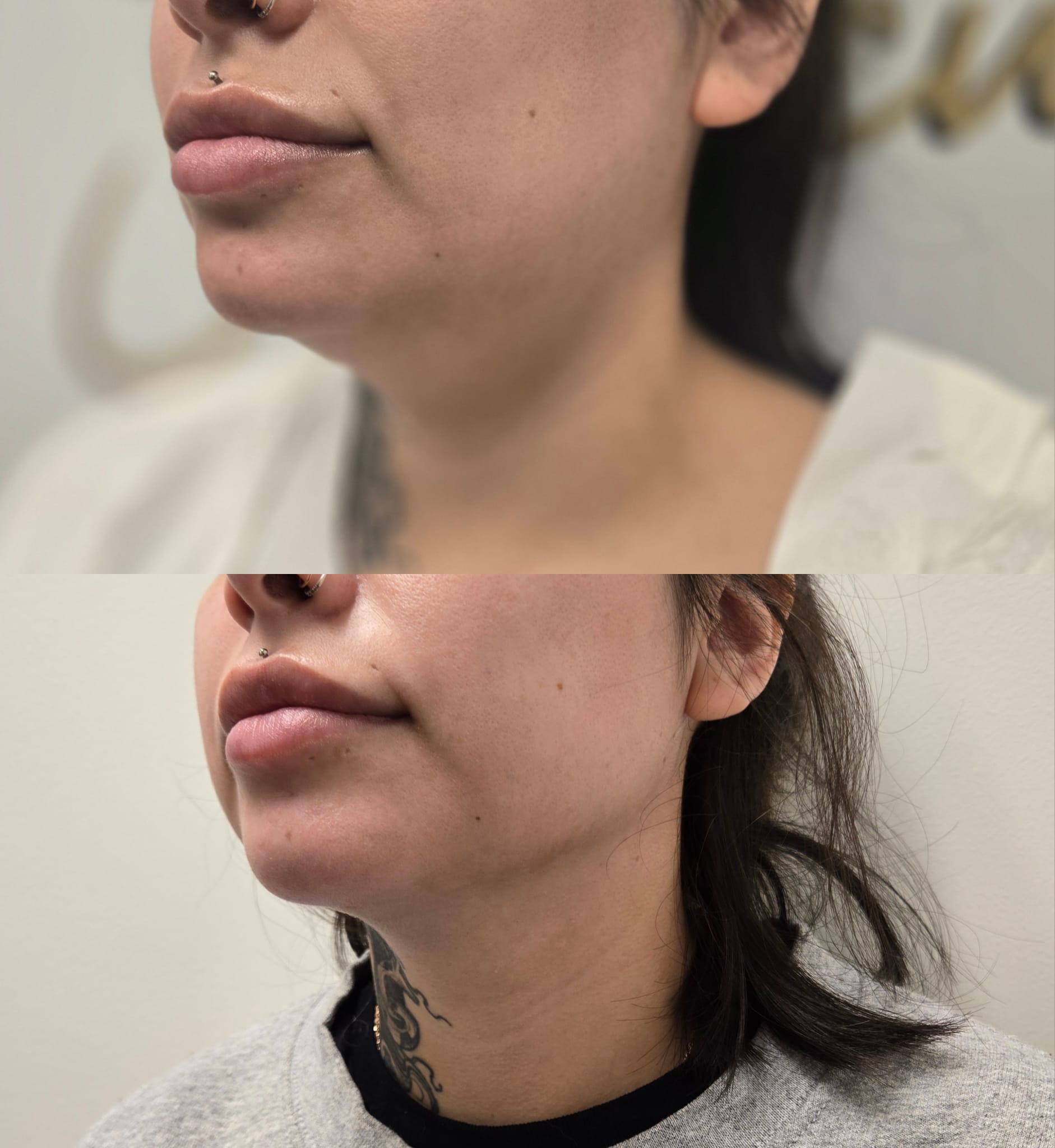 liposuction top treatment surgery in Oxnard