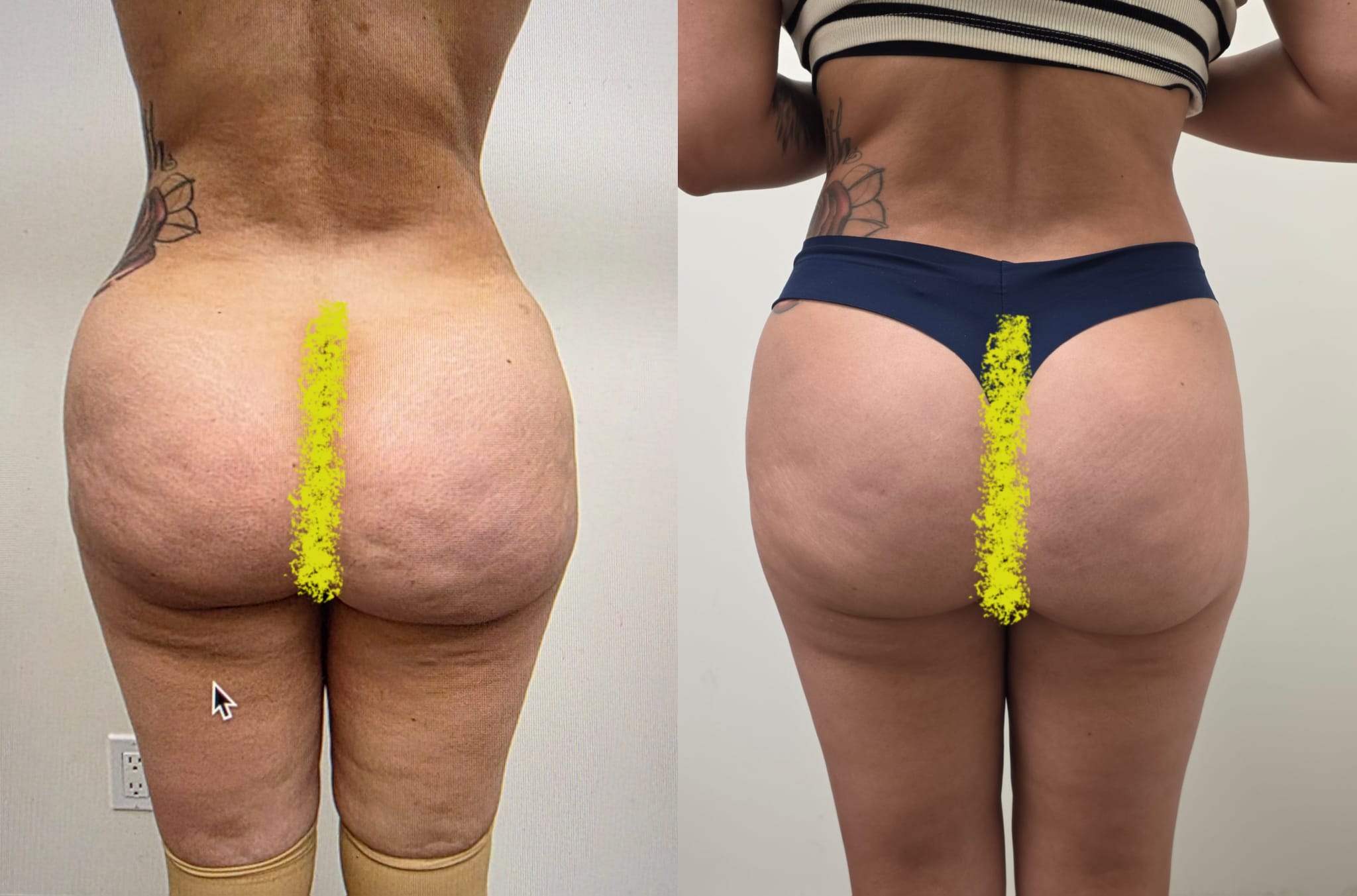 liposuction surgery before after results 2024