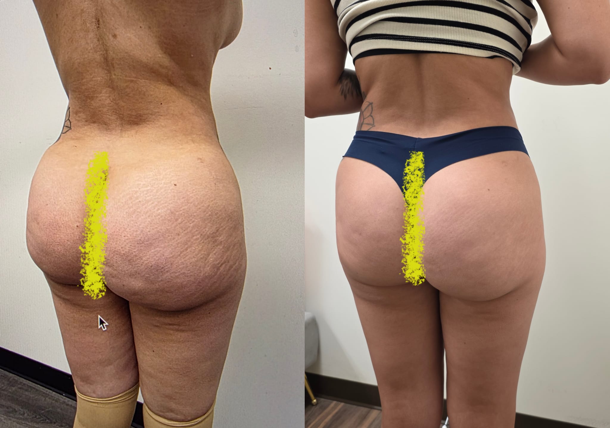 liposuction surgery before after results 2024