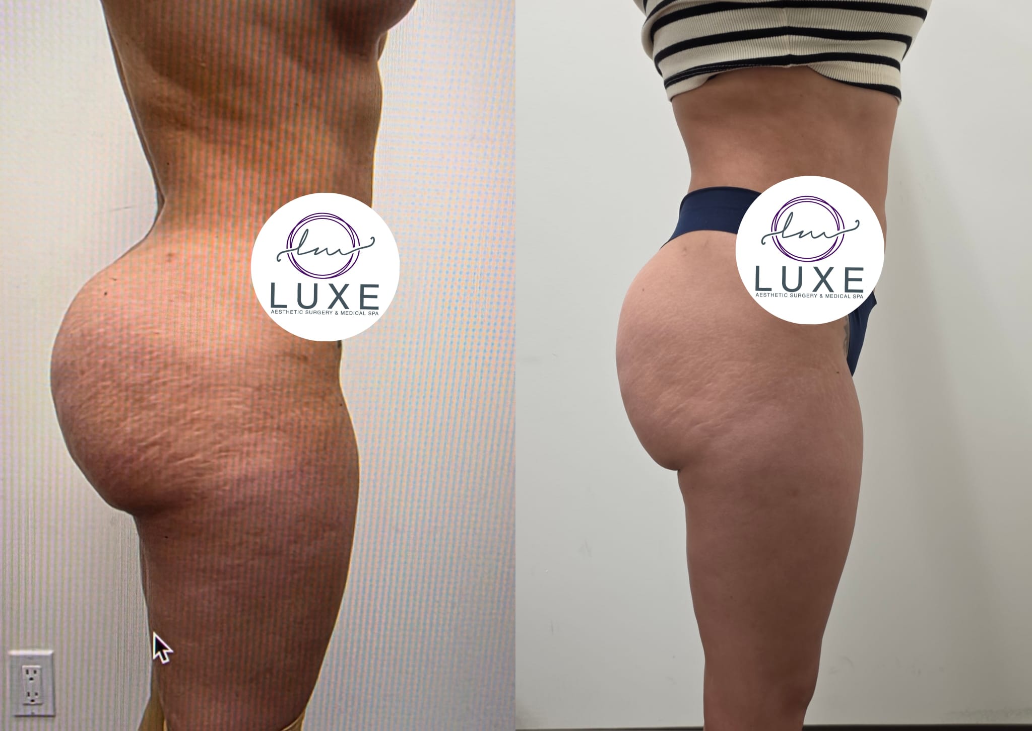 liposuction surgery before after results 2024