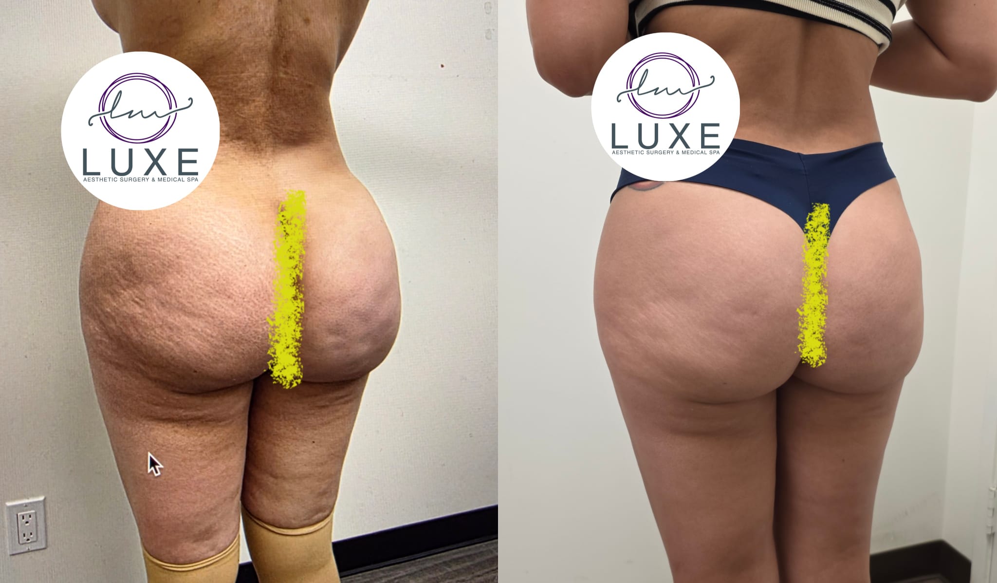 liposuction surgery before after results 2024
