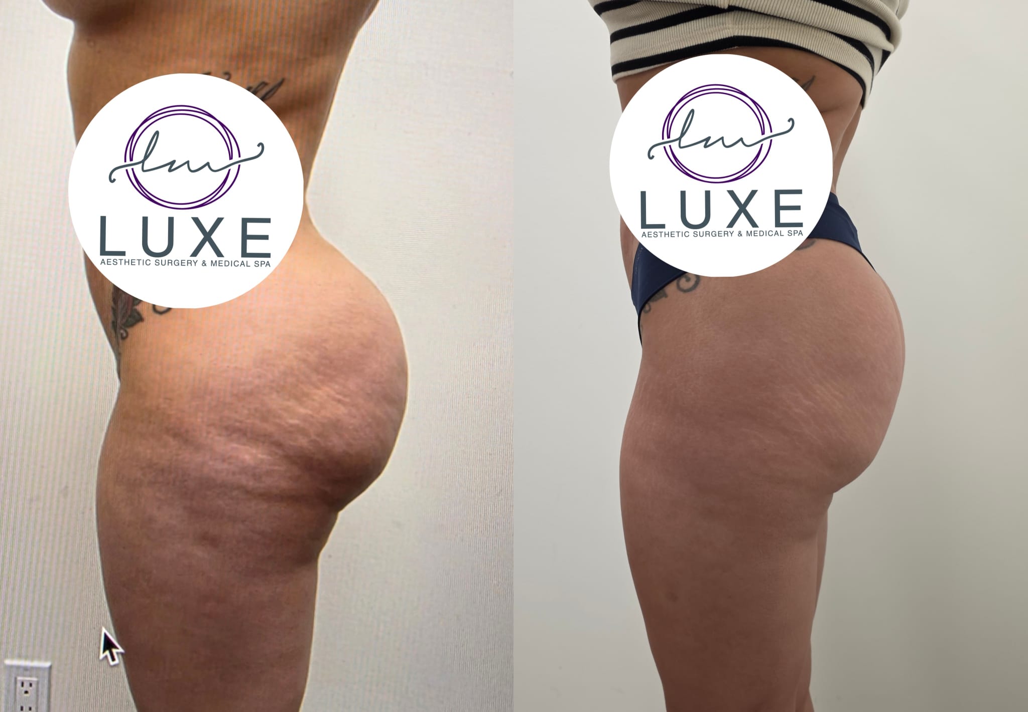 liposuction surgery before after results 2024