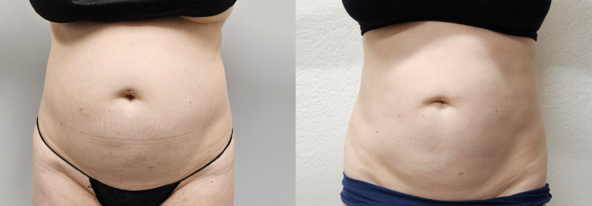 liposuction surgery before after results 2024