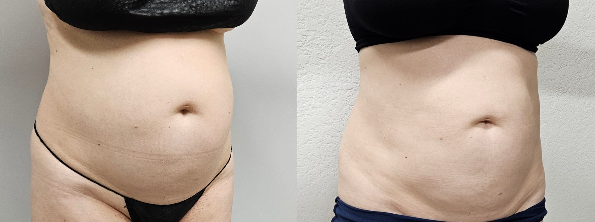 liposuction surgery before after results 2024
